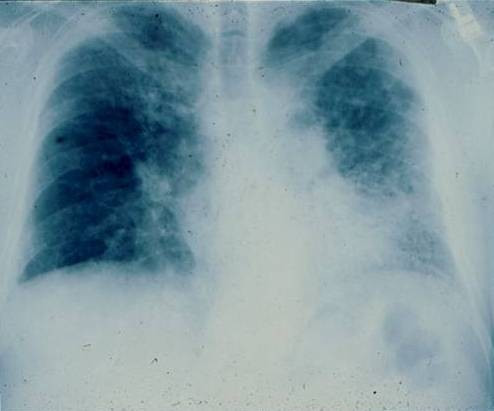 Radiografía simple de un paciente con fibrosis pulmonar idiopática (FPI). Patrón reticular de predominio en las bases.