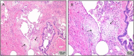 Biopsia pulmonar quirúrgica de un paciente con fibrosis pulmonar idiopática (FPI). A. Patrón histológico de neumonía intersticial usual (NIU): fibrosis, focos de fibroblastos (flechas) y escasas paredes alveolares casi normales (en el centro de la imagen). B. Imagen aumentada de los focos de fibroblastos (flechas). Tinción de hematoxilina-eosina.